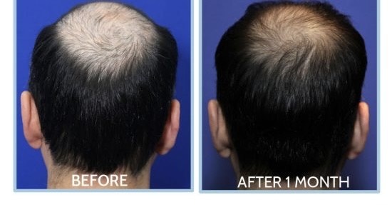 Stem Cells Injections for Hair